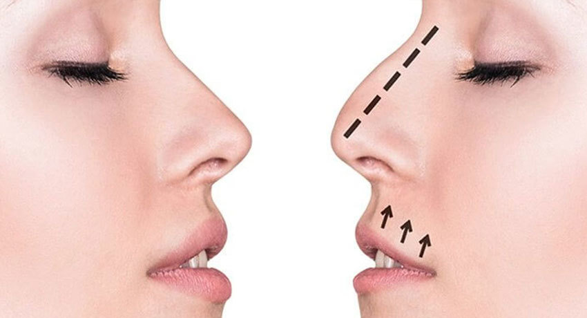 Ринопластика