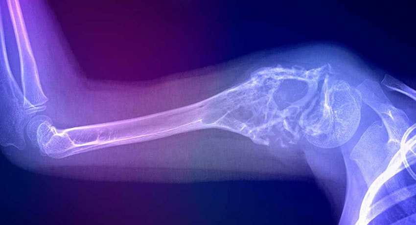 Саркома Юинга