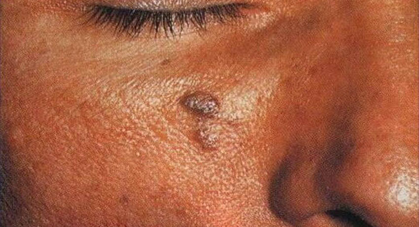 Саркома Капоши