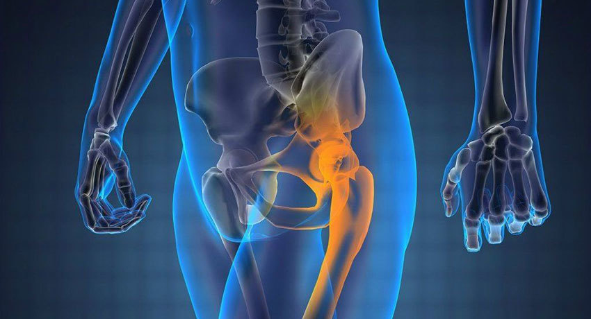 Саркома тазобедренного сустава