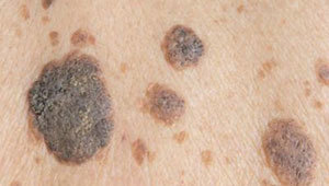 себорейные-кератомы