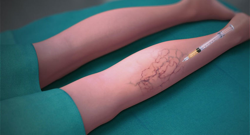 Склеротерапия в международной клинике Медика24