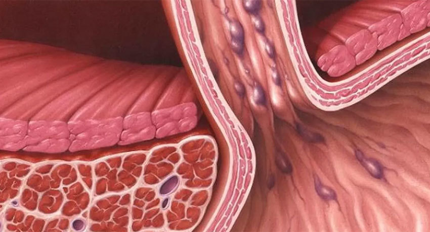 Варикозное расширение вен пищевода