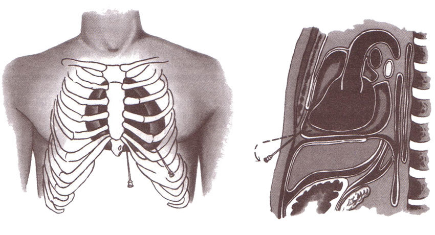 Средостение