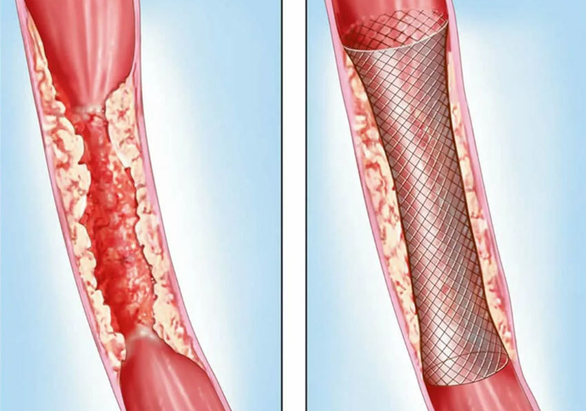 Стентирование кишечника