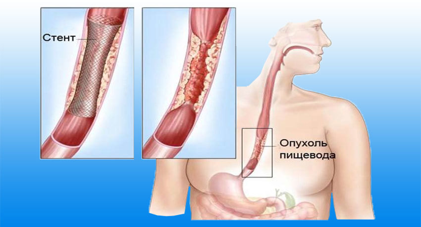 Стентирование пищевода