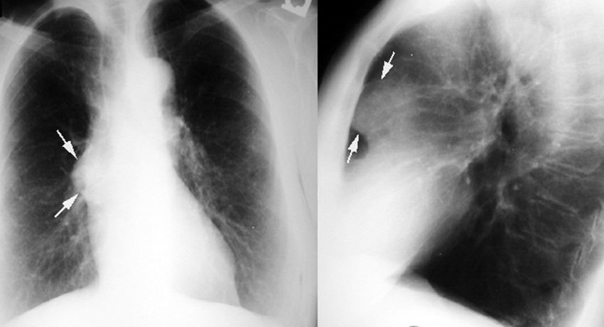 Тимома при рентгенографии