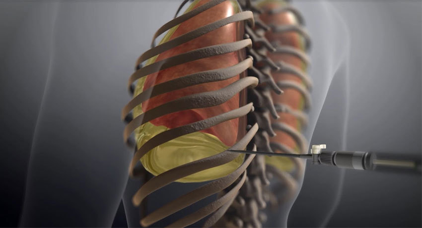 Торакоцентез