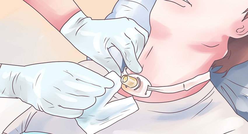 Наложение трахеостомы