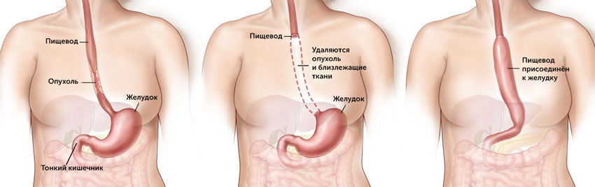 Удаление пищевода