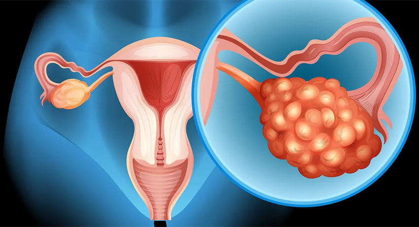 Удаление рака яичников