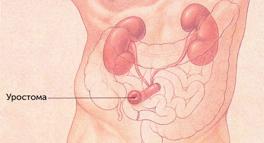 Уростома