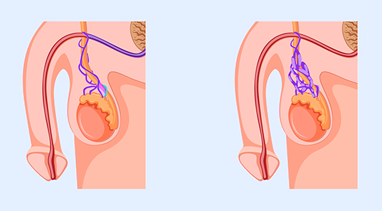 varikotsele