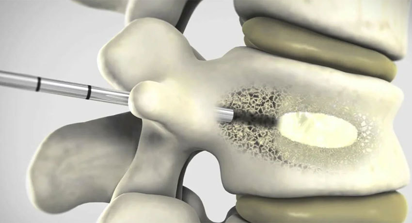 Проведение вертебропластики