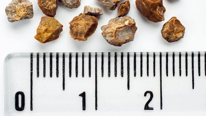 Камни в почках Камни в почках: фото