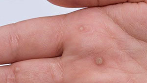 вирусные-бородавки