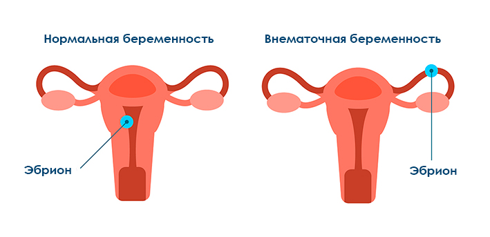 vnematochnaya-beremennost