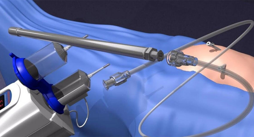 Внутрибрюшная (внутриплевральная) аэрозольная химиотерапия под давлением (PIРAC)
