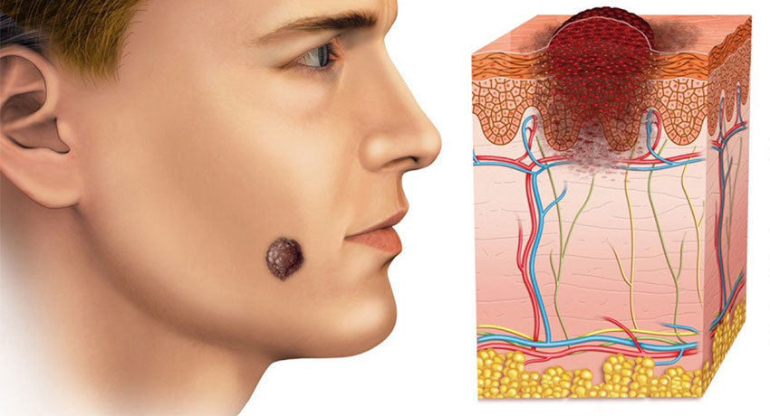 Злокачественные опухоли кожи