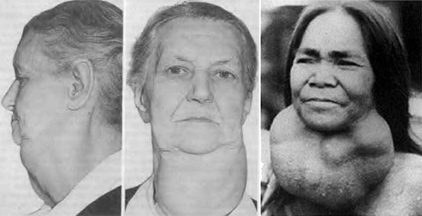 Виды зоба щитовидной железы